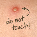 Do not touch your pimples! It will cause an increases in sebum production.