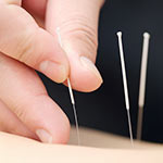 Dry Needling Myofascial treatment for chronic back pain, Caloundra Qld